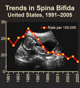 Trends in spina bifida